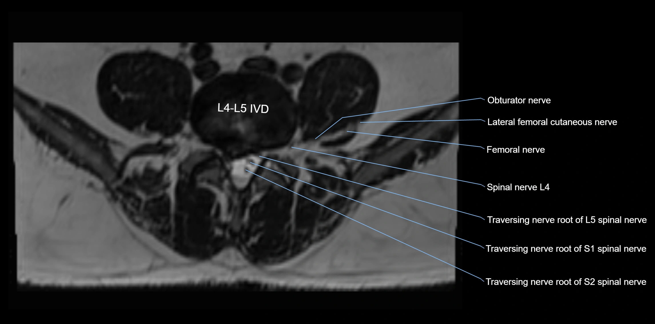 MR lumbosacral plexus axial cross sectional anatomy 3T  radiology  image-img-1008001-00048.webp